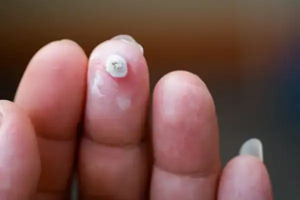 Image of white wart before cryopen treatment High Wycombe
