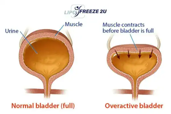 diagram of overactive bladder treatment High Wycombe