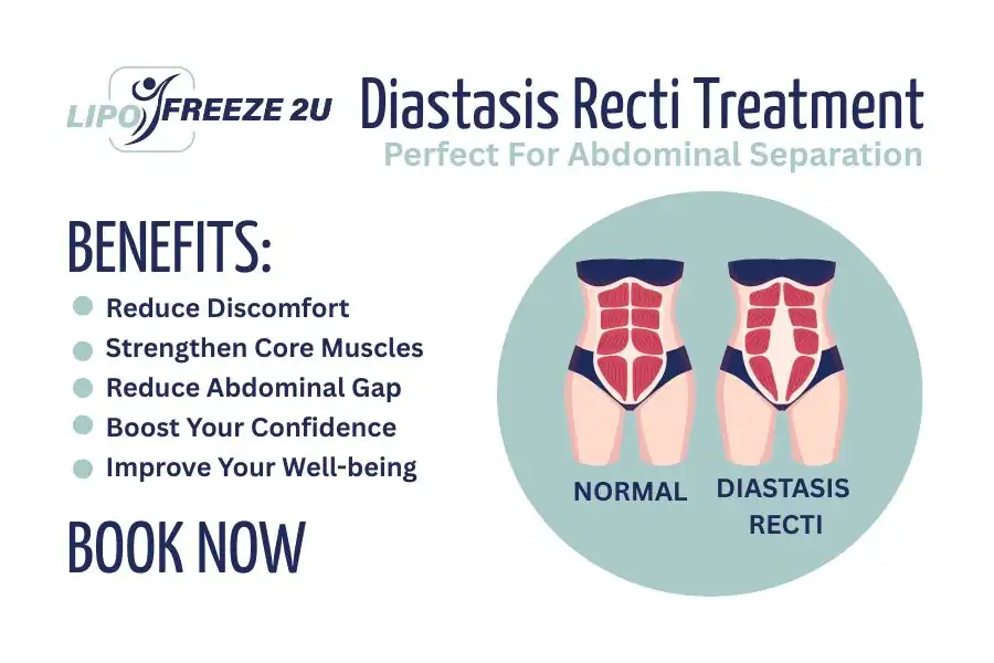 How Long Will It Take to See Improvements in Diastasis Recti High Wycombe