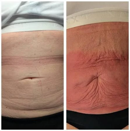 How Does RF Microneedling Improve Crepey, Thin and Uneven Skin Texture High Wycombe?