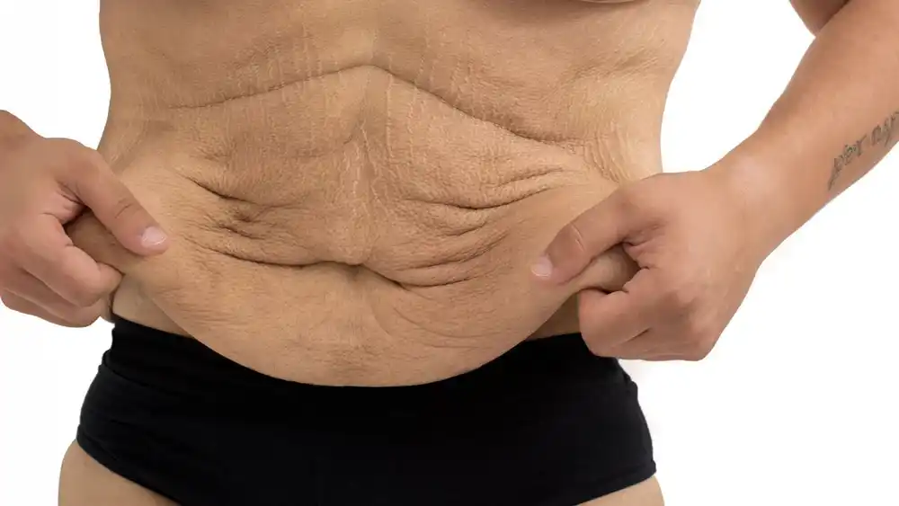 RF Microneedling for Loose Skin: How Can It Help Tighten and Reshape the Skin High Wycombe?